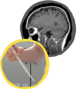 Cerebral